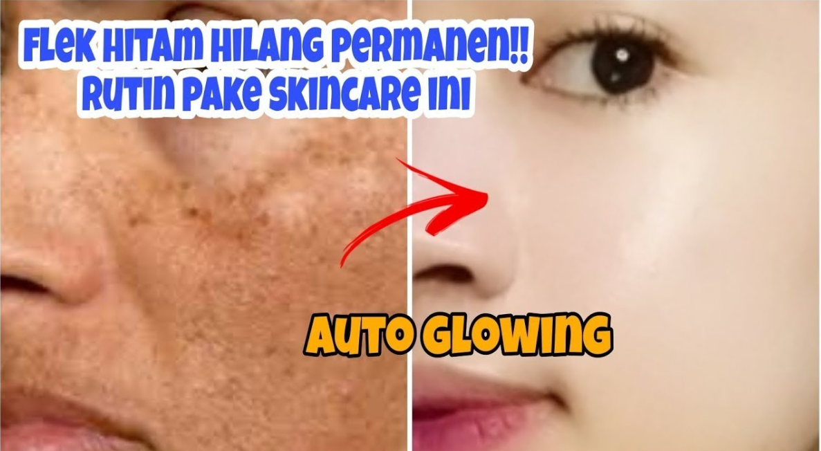 Inilah Produk Terbaik Skincare Wardah Untuk Menghilangkan Flek Hitam Di