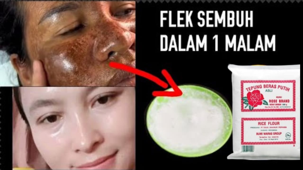 Inilah Cara Menghilangkan Flek Hitam dengan Tepung Beras, Cuma 1 Bahan Bikin Wajah Mulus Dalam Semalam