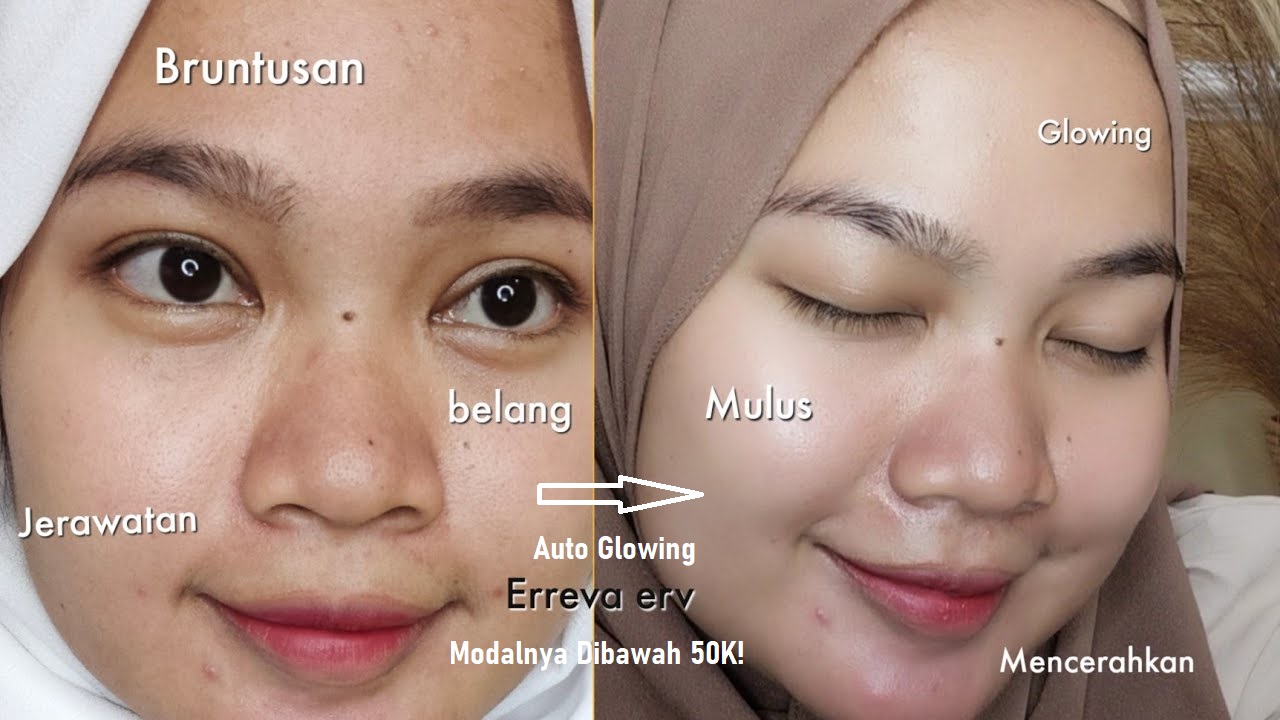 Serum Implora untuk Menghilangkan Bekas Jerawat, Bikin Wajah Glowing Sempurna Tanpa Bintik Hitam!