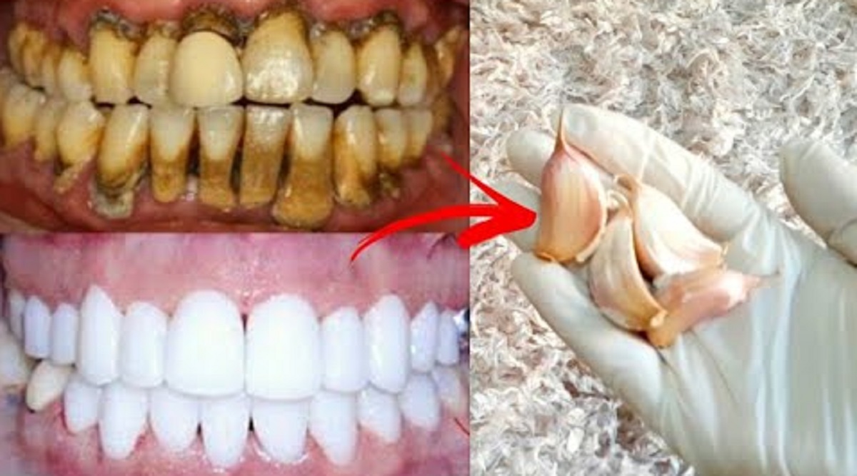 Ternyata Inilah 5 Penyebab Karang Gigi Menebal dan Mengeras, Lakukan Pencegan dengan Cara Gampang Berikut Ini