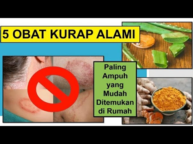 Inilah Cara Mengatasi Kadas Dengan Bahan Alami, Ada 5 Rekomendasi yang Bisa Kamu Coba