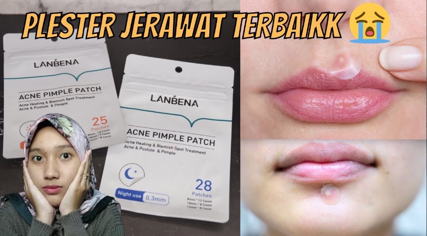 4 Rekomendasi Acne Patch untuk Mempercepat Penyembuhan Jerawat, Solusi Cegah Noda Gelap Parah