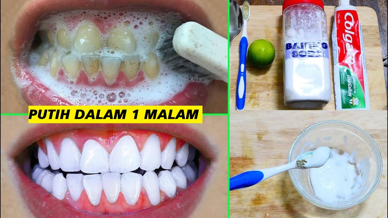 Inilah Cara Memutihkan Gigi Kuning yang Berkarang secara Alami dalam 1 Hari, Gigi Putih Bersih Aman Bebas Noda