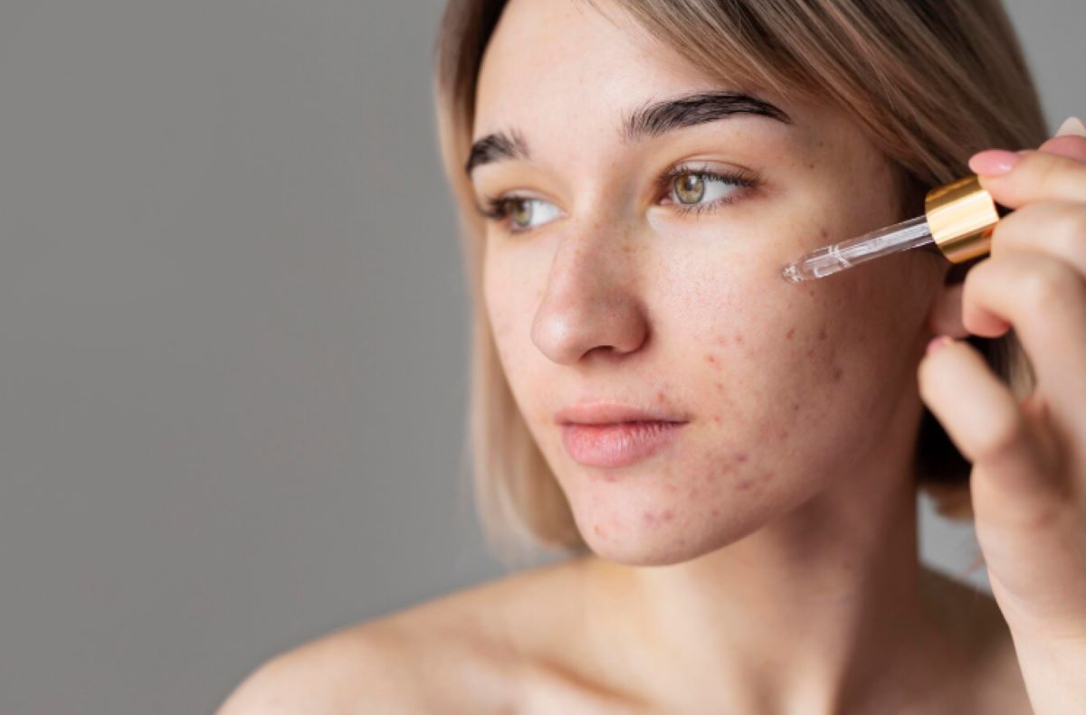 Mengenal Bahan Kaya Manfaat, Apa itu Salicylic Acid, Manfaat, serta Rekomendasi Produknya