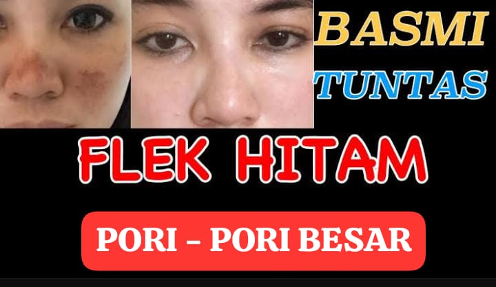 Cara Menghilangkan Flek Hitam dan Mengecilkan Pori-Pori Pakai 1 Bahan Dapur, Glowing dan Mulus Anti Repot