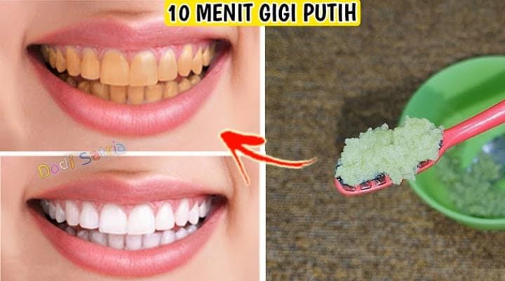 Begini Cara Cepat Memutihkan Gigi dengan Bahan Alami, 1 Kali Pakai Terlihat Hasilnya Karang Gigi Auto Rontok
