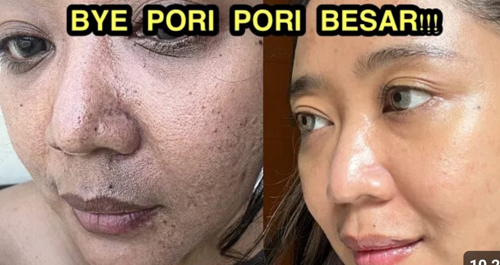 6 Pilihan Terbaik Skincare untuk Pori Besar! Efektif Bikin Wajah Mulus dan Putih Cuma Dalam Semalam Saja