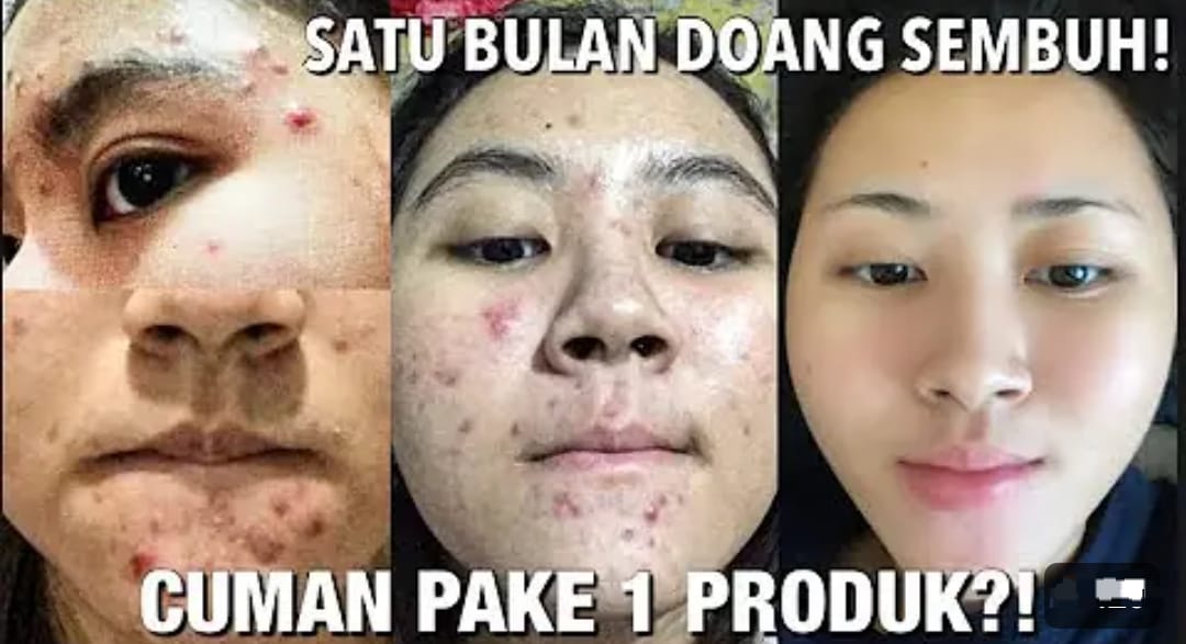 3 Cara Menghilangkan Jerawat Batu Dalam Semalam, Cuma Pakai Bahan Dapur Murah Wajah jadi Glowing