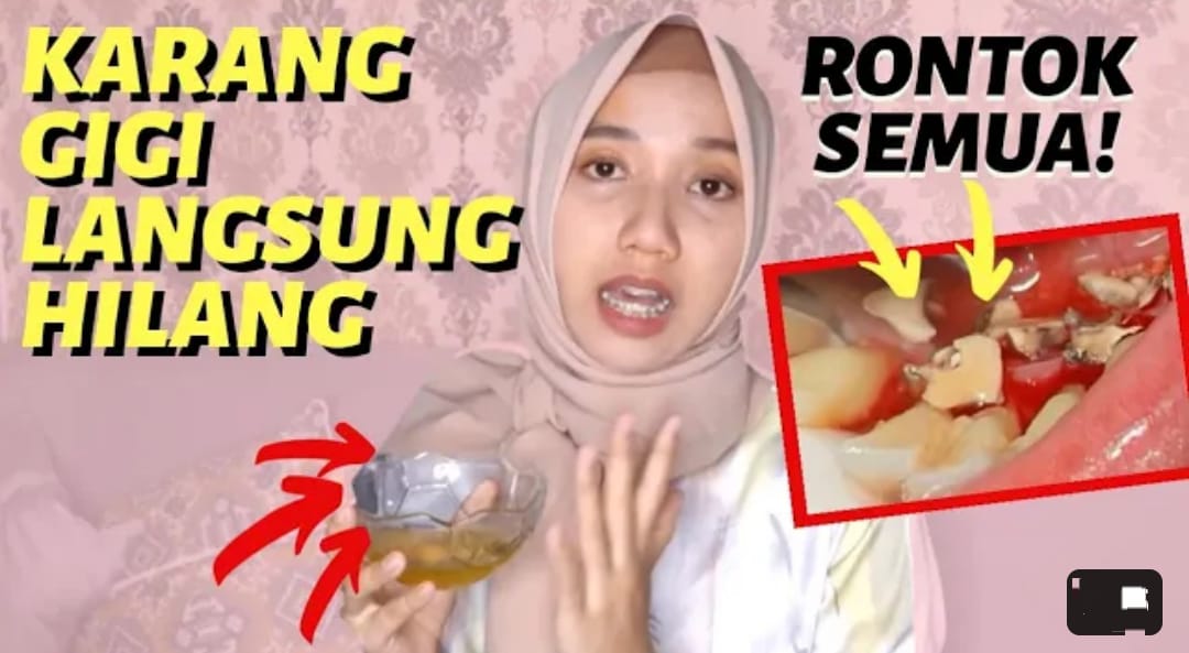 Begini 4 Cara Menghilangkan Karang Gigi Dengan Cepat Secara Alami, Cuma Bumbu Dapur Gigi Putih dan Bebas Plak 