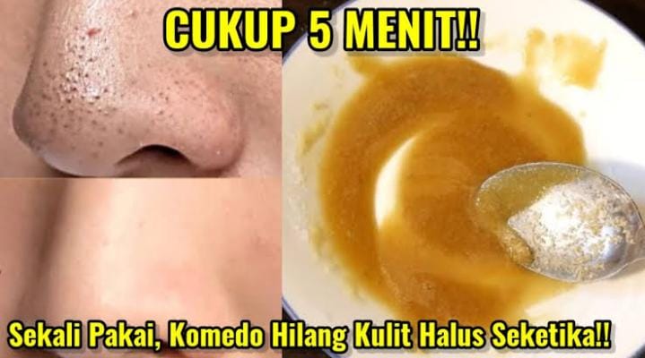 2 Masker Bahan Dapur Penghilang Komedo, Bantu Kecilkan Pori-Pori Bikin Wajah Mulus dan Glowing