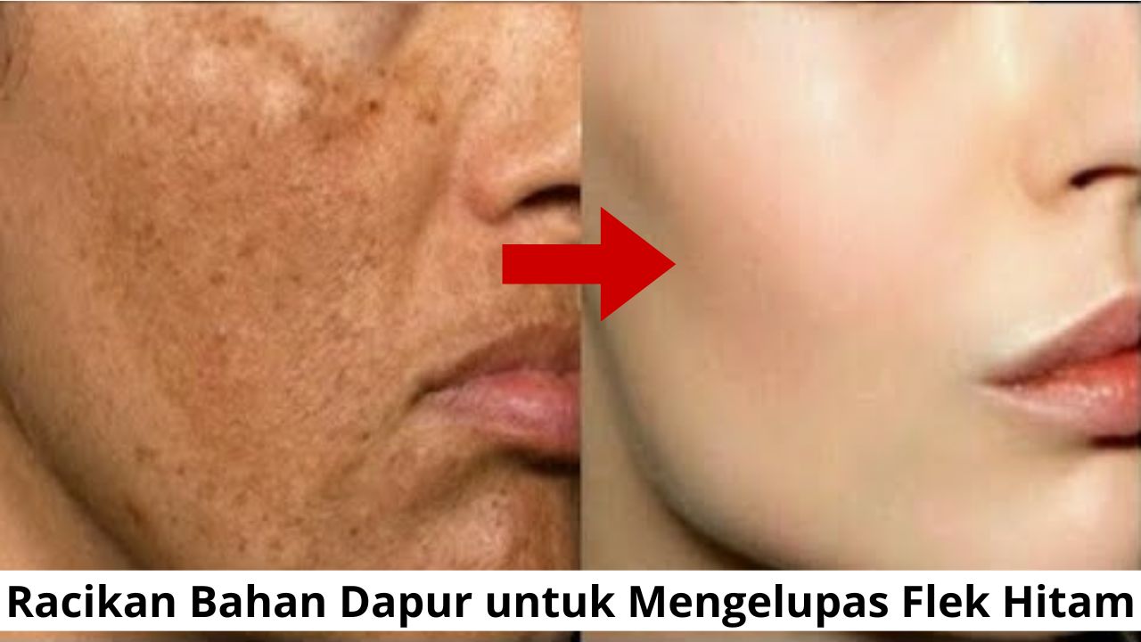 Racikan Bahan Dapur untuk Mengelupas Flek Hitam dengan Cepat, 2 Bahan Begini Cara Meraciknya