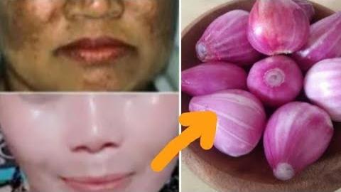 2 Cara Ampuh Menghilangkan Flek Hitam di Wajah dengan Bahan Alami, Kulit Cerah Awet Muda Tanpa Skincare Mahal