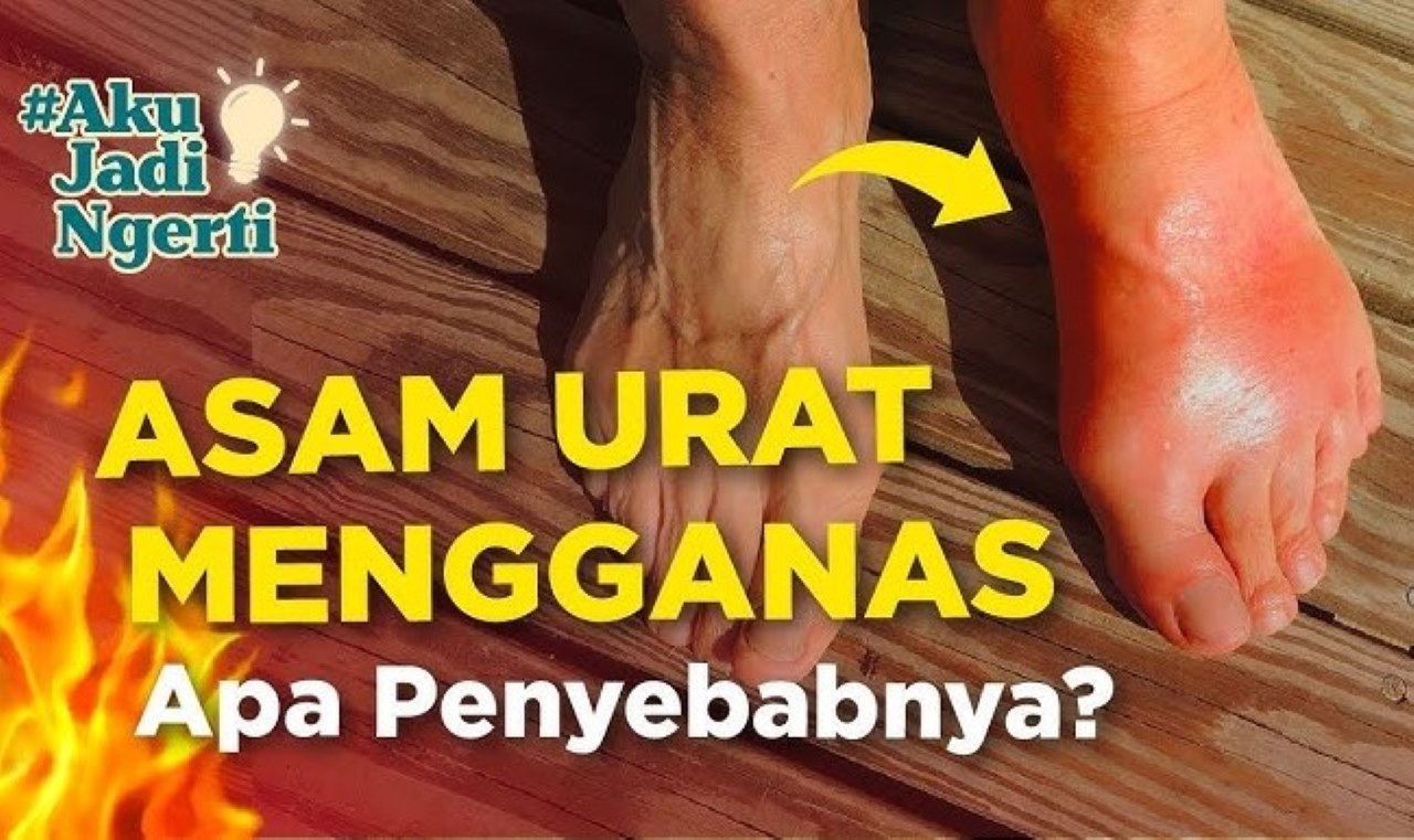 Sering Panasan Bisa Bikin Asam Urat? 7 Kebiasaan Buruk yang Bisa Menyebabkan Asam Urat yang Wajib Diketahui!