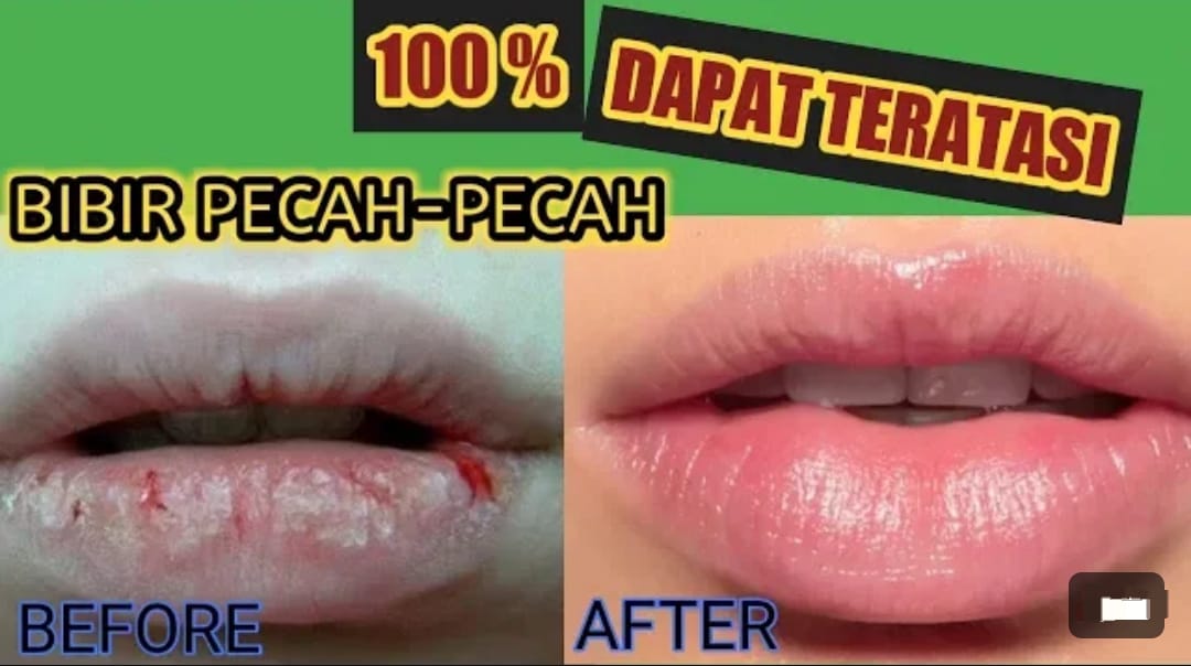 4 Cara Mengatasi Bibir Pecah-Pecah dan Mengelupas Dengan Bahan Dapur, Ampuh Cerahkan Bibir Hitam