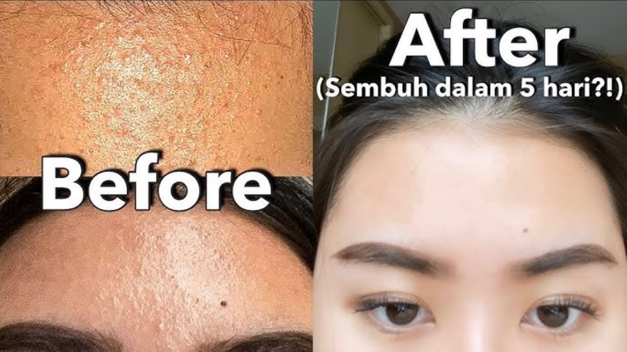 Cara Menghilangkan Bruntusan dengan Bahan Alami, Pakai 1 Jenis Protein Ini