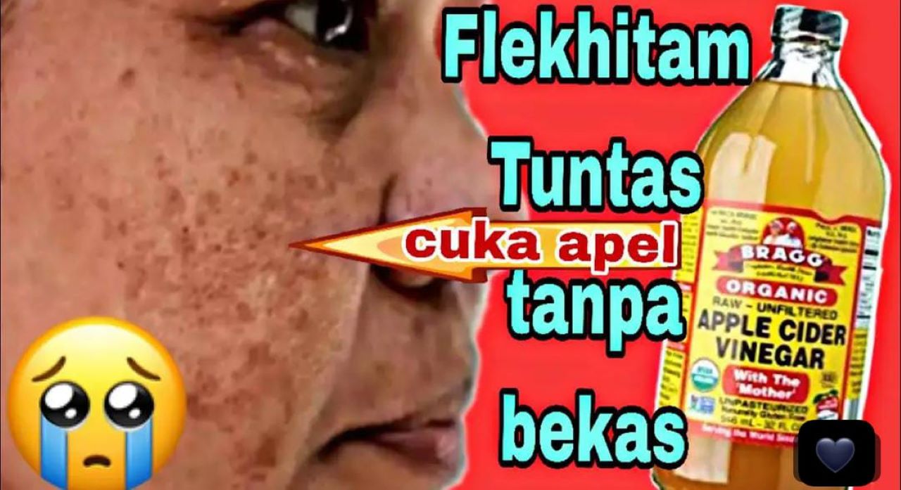 DIY Racikan Cuka Apel Pemutih Wajah Untuk Wajah Glowing, Bonus Hilangkan Flek Hitam