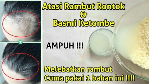 3 Cara Mengatasi Rambut Rontok Parah Secara Alami, Bikin Rambut Kuat Bebas Kebotakan dan Uban