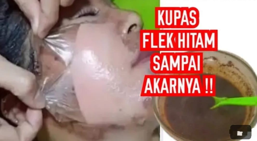 3 Cara Menghilangkan Flek Hitam di Muka Pakai Bahan Dapur Dalam 1 Malam, Wajah Langsung Mulus Kencang Permanen