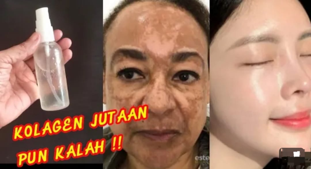 3 Cara Mudah Menghilangkan Flek Hitam di Wajah Dengan Bahan Alami, Flek Langsung Hilang Kulit jadi Kencang