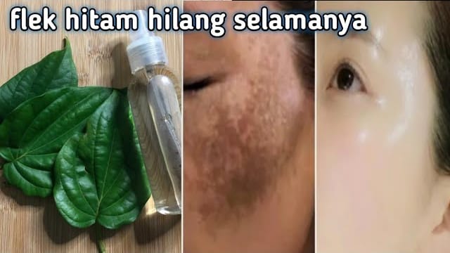 Ternyata, Ini 3 Cara Pakai Daun Sirih untuk Flek Hitam Efektif Bikin Wajah Glowing Bebas Noda dan Kerutan