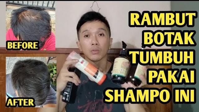 4 Shampo Penumbuh Rambut di Indomaret, Bikin Rambut Botak Hilang Cepat Tumbuh dan Lebat dalam 1 Minggu