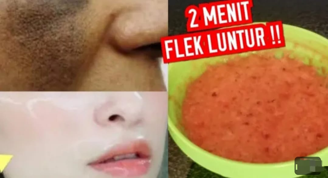 2 Cara Menghilangkan Flek Hitam Terbukti dengan Bahan Dapur, Kulit Langsung Kencang Bonus Pori-Pori Mengecil