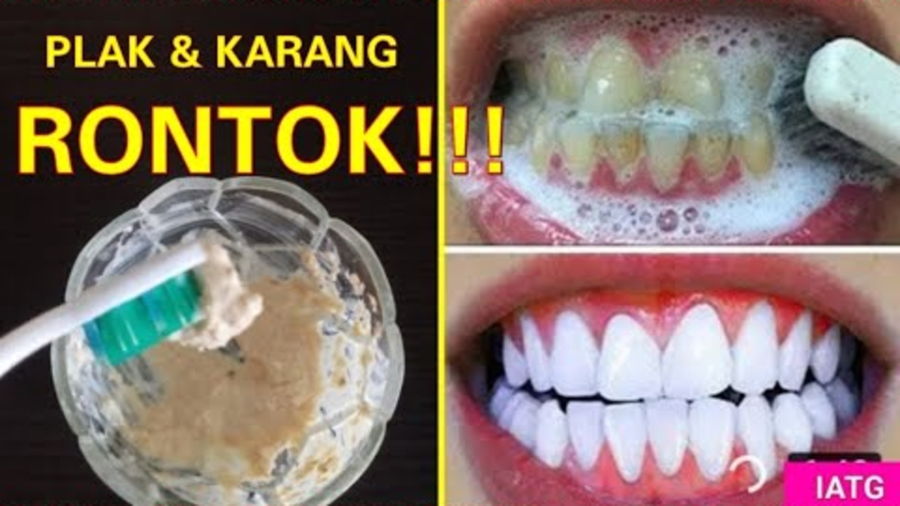 Begini Cara Membersihkan Karang Gigi yang Sudah Mengeras, Cuma 1 Bahan Nafas Segar Seharian!