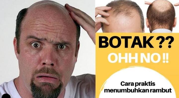 Cara Mengatasi Rambut Botak dan Rontok Secara Alami, Cukup Pakai 3 Bahan Rumahan Rambut Jadi Lebat