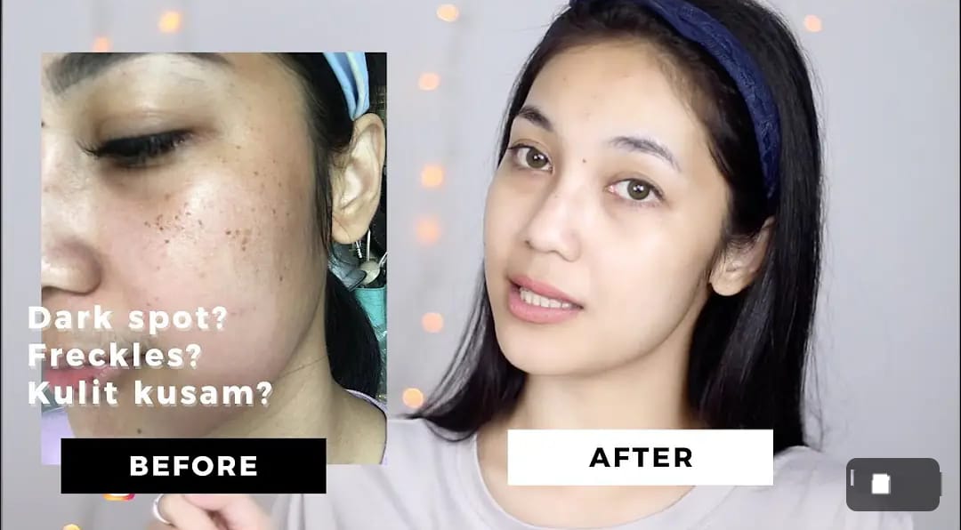 4 Cara Menghilangkan Bintik Hitam di Wajah Dengan Cepat Secara Alami, Wajah Langsung Glowing Awet Muda