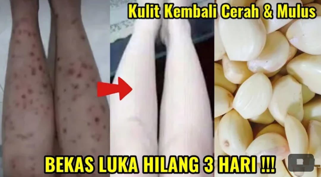 3 Cara Menghilangkan Bekas Koreng yang Menghitam Secara Alami dan Permanen, Kulit jadi Putih Kenyal Bebas Noda