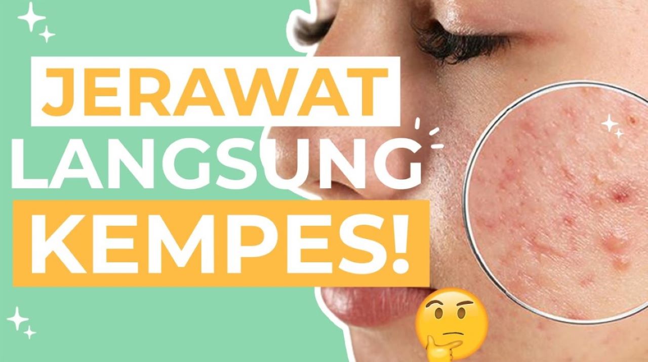Cuma Semalam! 5 Cara Membuat Jerawat Kempes dengan Cepat, dari Bahan Alami hingga Produk Khusus 