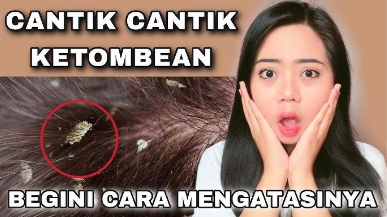 Trik Basmi Ketombe dengan Bumbu Dapur, 2 Bahan Bonus Rambut Anti Rontok 