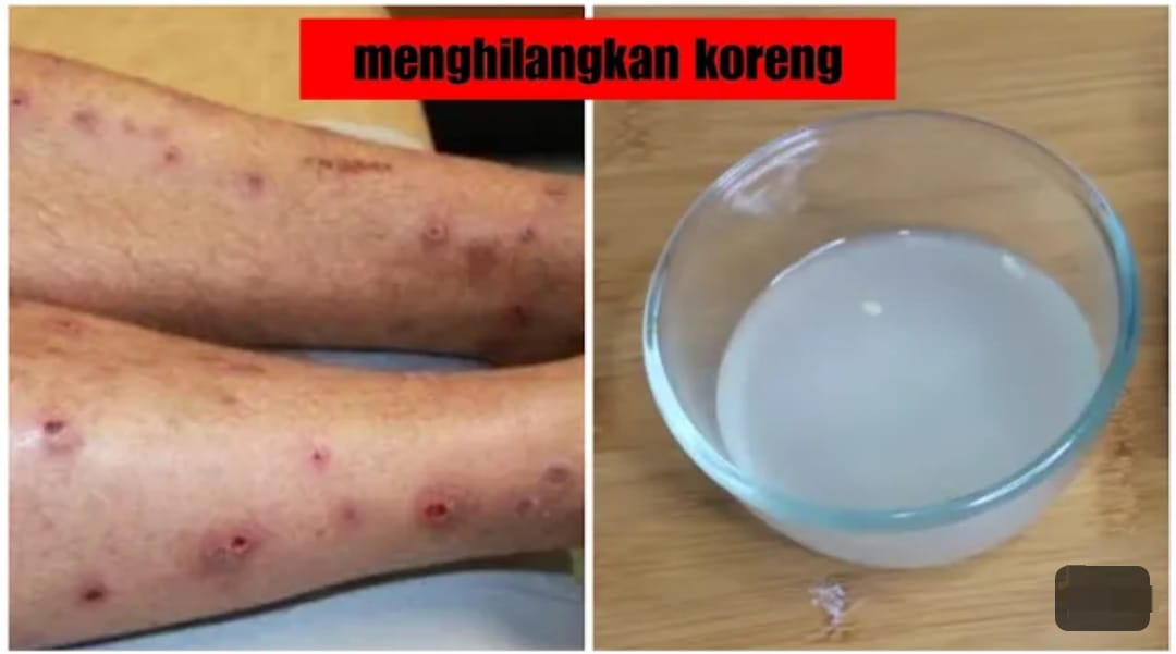 3 Cara Menghilangkan Bekas Hitam di Kaki yang Sudah Lama, Cuma Pakai Bahan Dapur yang ada Di Rumah