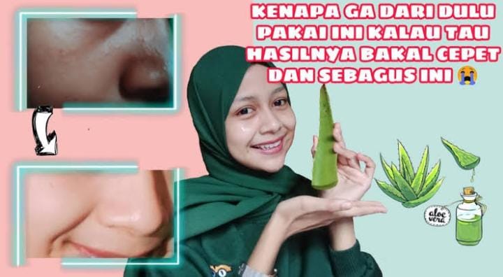 4 Cara Menggunakan Lidah Buaya untuk Memutihkan Wajah yang Paling Ampuh, Saatnya Berpisah dengan Noda Hitam