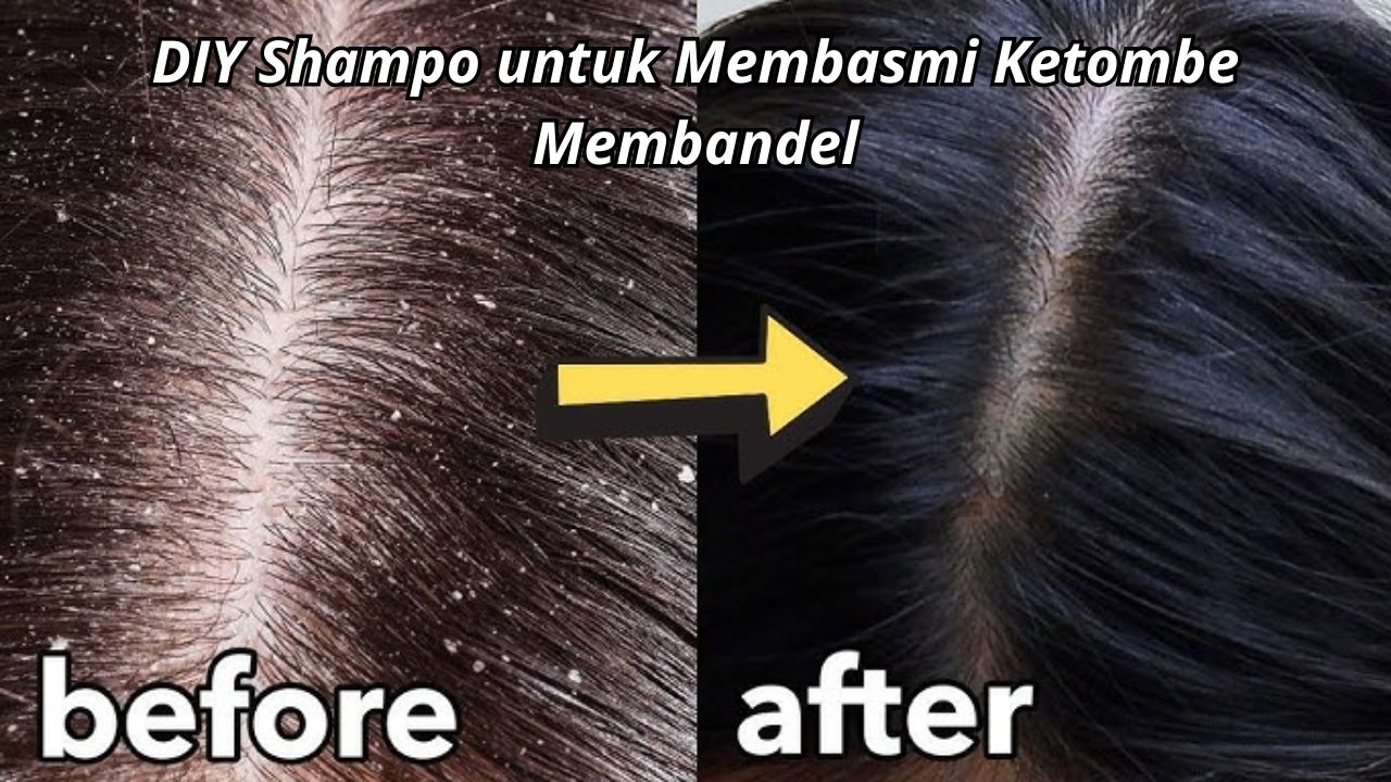 DIY Shampo untuk Membasmi Ketombe Membandel, Begini Cara Membuatnya