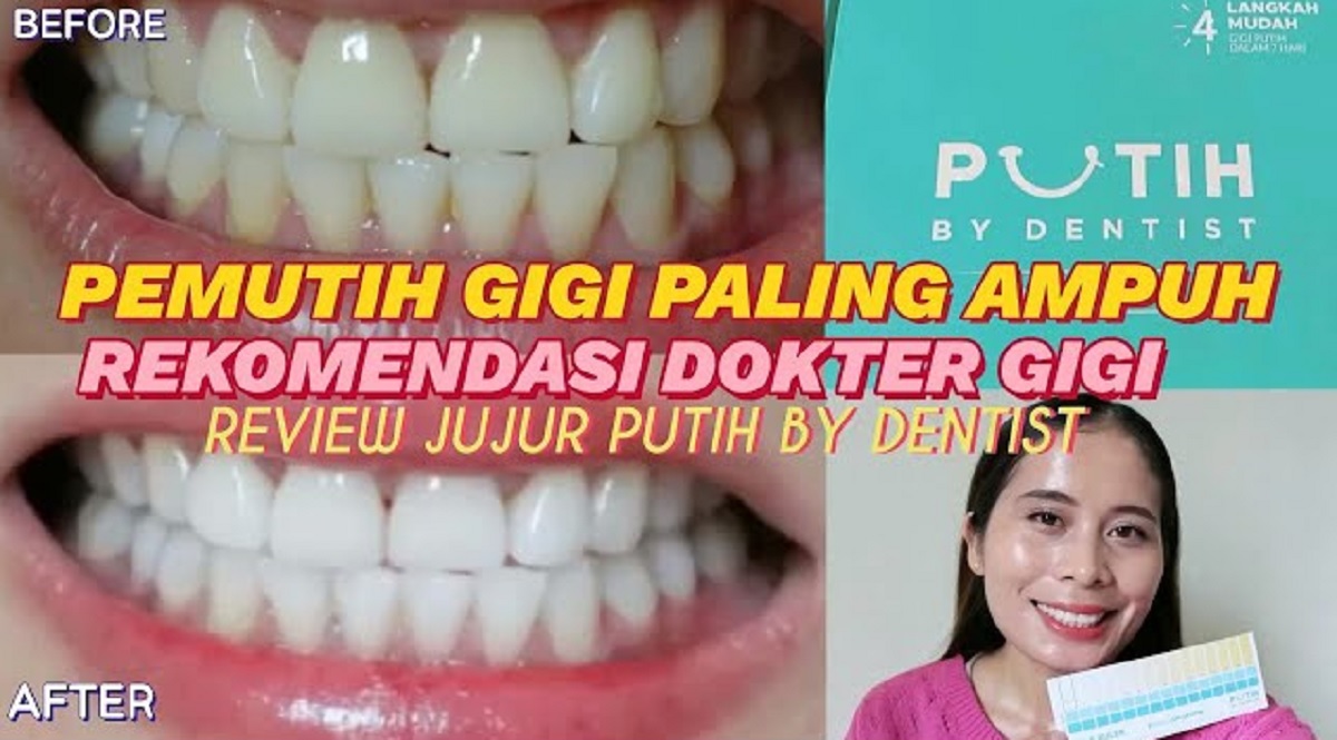 2 Merek Pemutih Gigi terbaik di Indomaret, Ampuh Putihkan Gigi dan Rontokkan Karang Menahun dalam 5 Menit