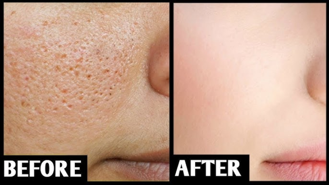 Cara Sederhana Menghilangkan Pori-Pori Besar di Pipi Secara Alami, Cuma 1 Bahan Bikin Mulus Seketika