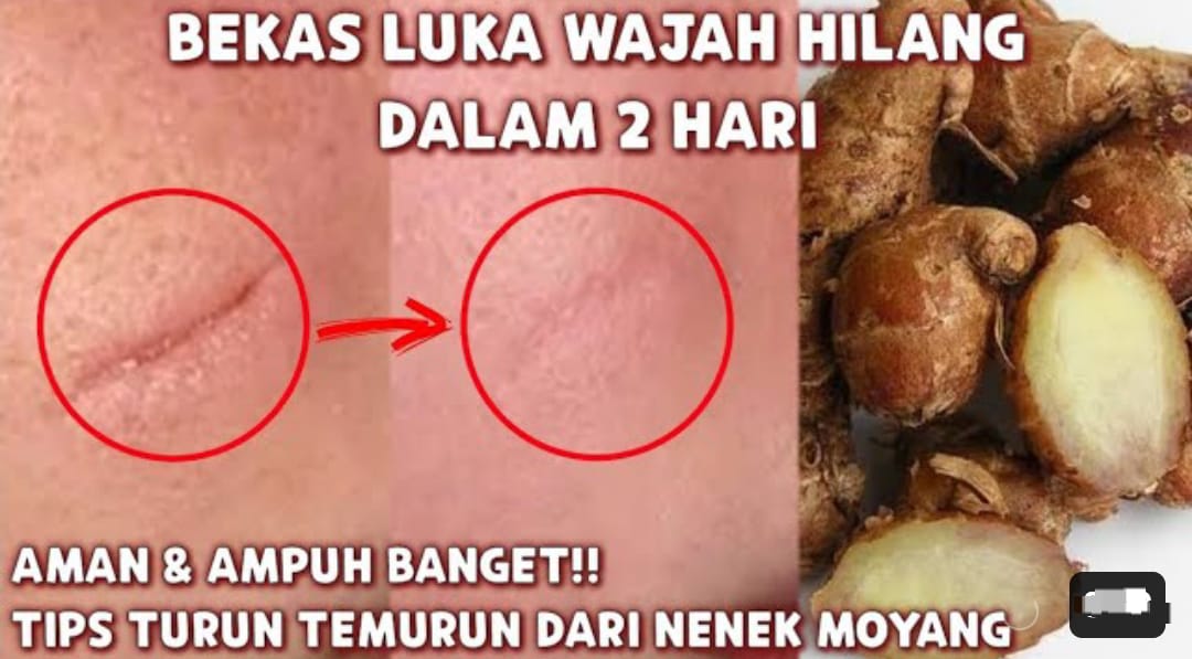 4 Cara Menghilangkan Bekas Luka Hitam di Wajah Dalam 1 Hari, Wajah jadi Glowing Bebas Noda Hitam Permanen