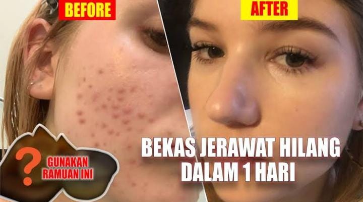 Begini Cara Agar Jerawat Hilang dengan Cepat dalam 1 Hari, Cuma Pakai Bahan Alami Bikin Percaya Diri Lagi