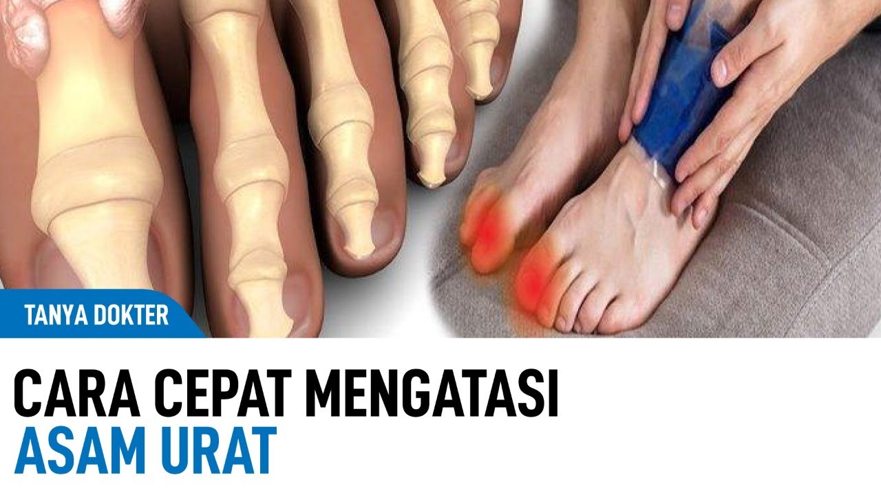 4 Cara Menghilangkan Nyeri Asam Urat dengan Cepat secara Alami, Cocok untuk Lansia 60 Tahun