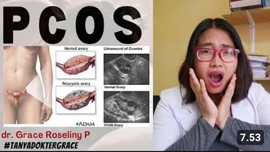 Apa itu PCOS yang Sering Terjadi pada Wanita? Yuk Simak 5 Gejala yang Muncul dan Sangat Menganggu