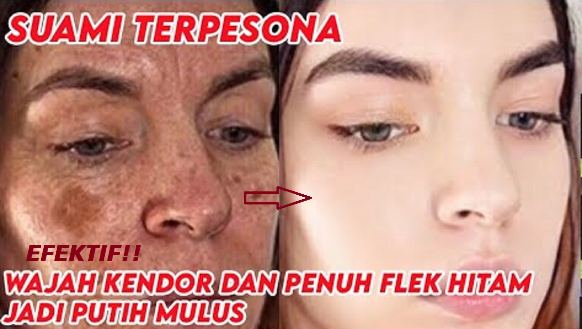 4 Cara Sederhana Menghilangkan Flek Hitam di Wajah dengan Bahan Alami, Kulit Mulus Glowing Bebas Noda