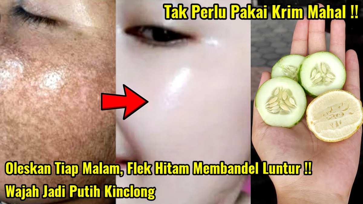 Cara Simpel Mengatasi Flek Hitam di Wajah yang Membandel Cuma Pakai 3 Bahan Ini Wajah Glowing Bebas Noda Hitam