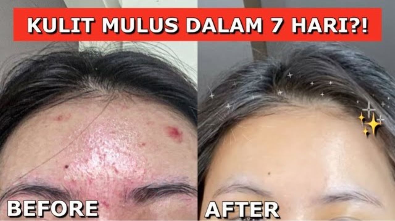 Cara Sembuhkan Jerawat dan Pudarkan Bekasnya Secara Alami, Pakai 1 Bahan Ampuh!