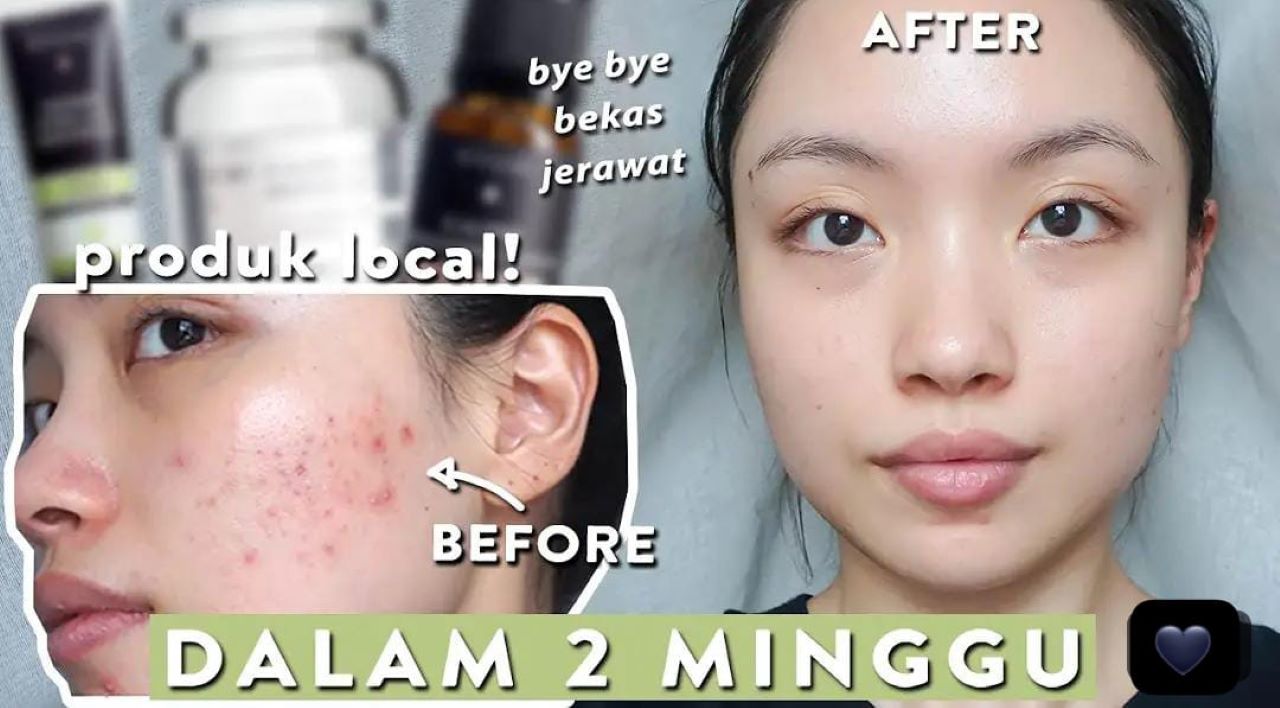 5 Merk Masker untuk Menghilangkan Bekas Jerawat Hitam Dengan Cepat