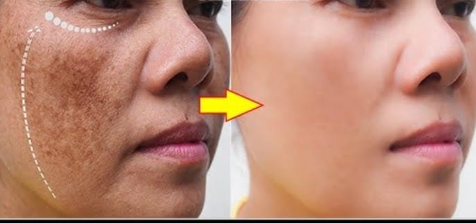 4 Sunscreen Terbaik untuk Flek Hitam Menahun, Bantu Kecilkan Pori Bikin Wajah Glowing dan Mulus