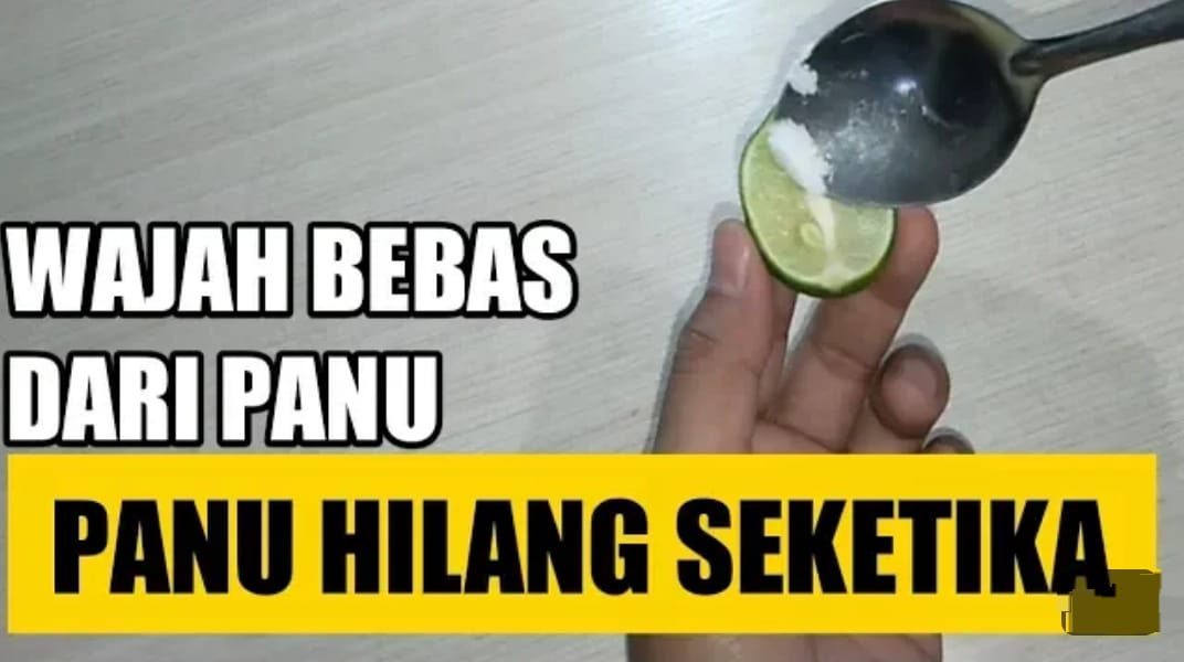 3 Cara Cepat Menghilangkan Panu di Wajah Secara Alami, Kulit jadi Putih dan Bersih Cuma Pakai 1 Bahan Dapur