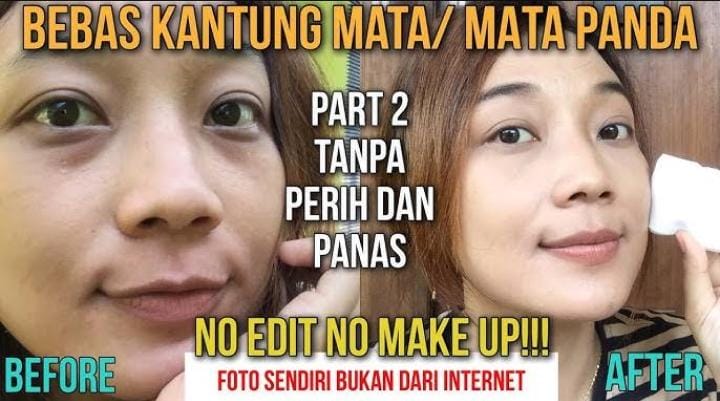 Cara Instan Menghilangkan Kantung Mata Hitam dengan Tomat dalam 1 Malam, Bye Lingkaran Hitam