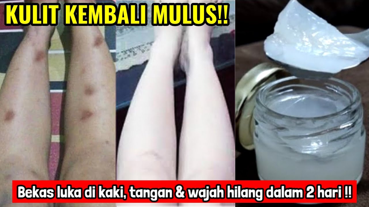 3 Cara Menghilangkan Bekas Koreng yang Menghitam dengan Cepat, Kulit Jadi Putih Mulus Permanen Sekali Pakai