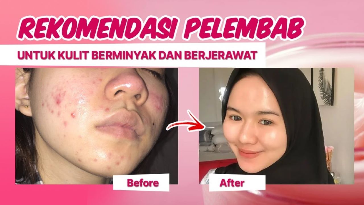 4 Pelembap untuk Kulit Berminyak dan Berjerawat yang Bikin Kulit Tampak Sehat dan Segar 